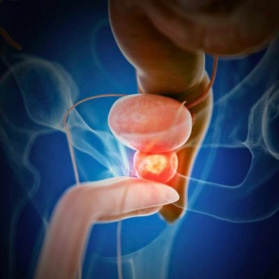 Cancer de Prostata editado Cancer de Prostata editado